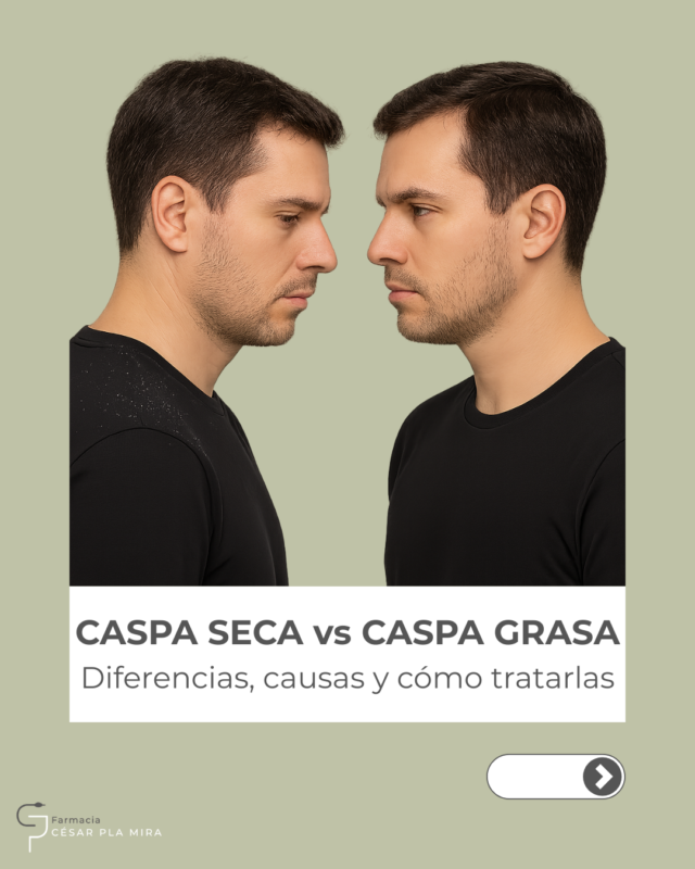 Imagen comparativa para ilustrar las diferencias visibles entre caspa seca y caspa grasa desde un enfoque dermofarmacéutico.